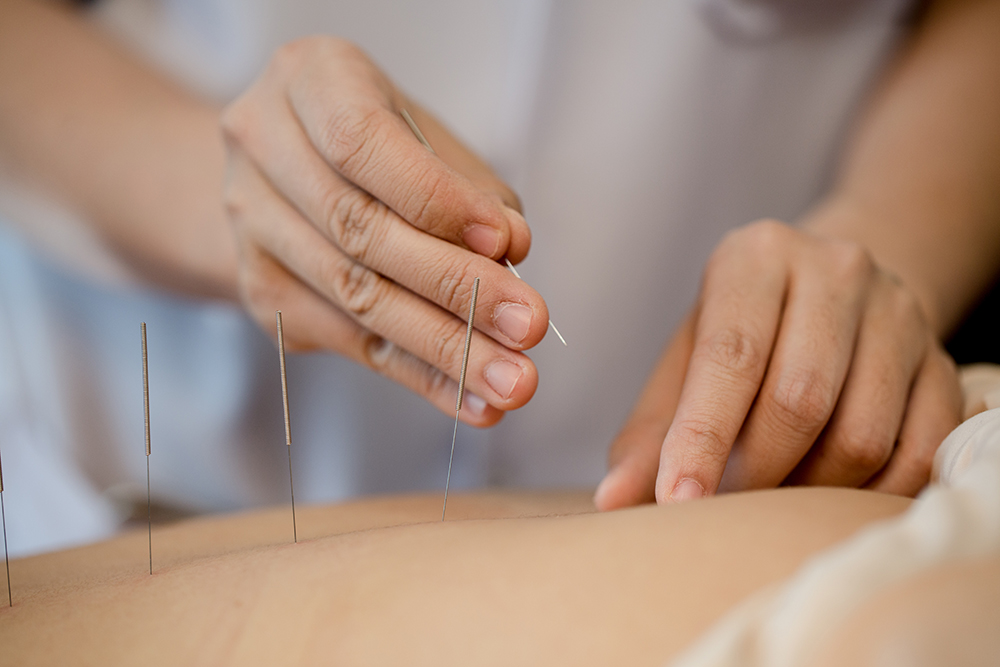 Chiropractic Acupuncture Treatment