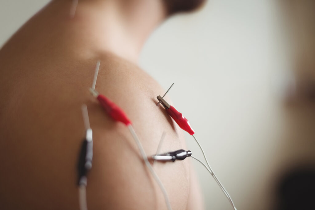 chiropractic acupunture closeup on patient