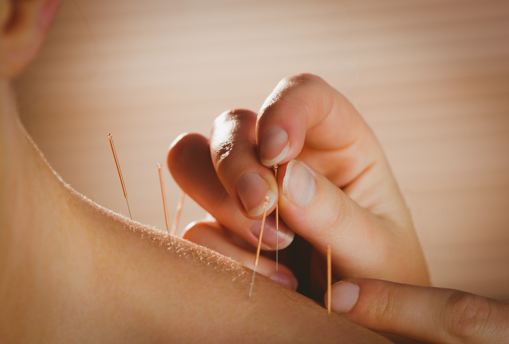 patient receiving tcm acupuncture treatment on the shoulder